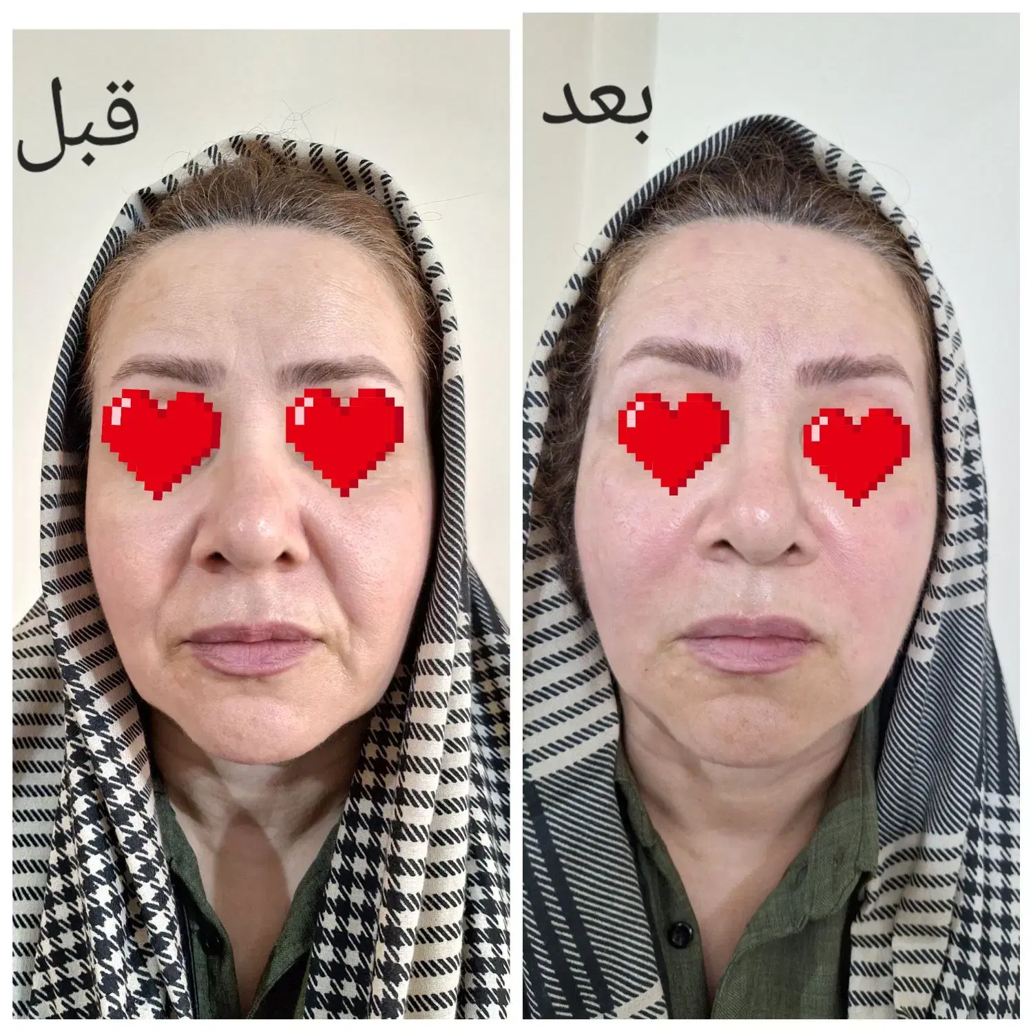 نخ فیلر|خدمات آرایشگری و زیبایی|تبریز, |دیوار