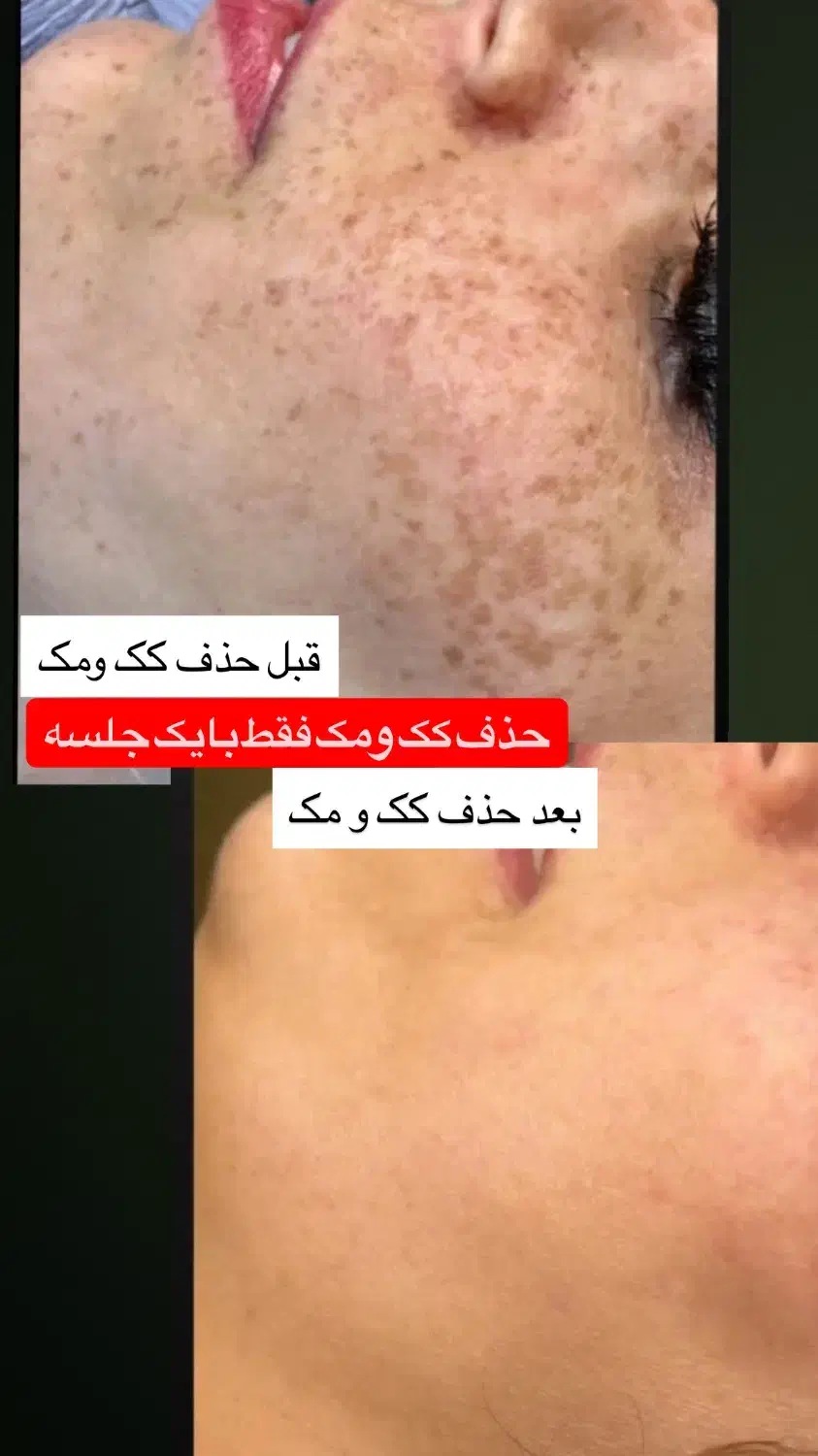 درمان مشکلات پوستی|خدمات آرایشگری و زیبایی|شاهین دژ, |دیوار