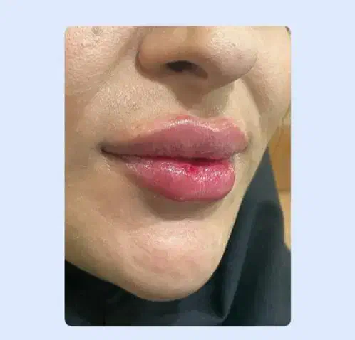 تزریق ژل و بوتاکس|خدمات آرایشگری و زیبایی|قم, صدوق|دیوار