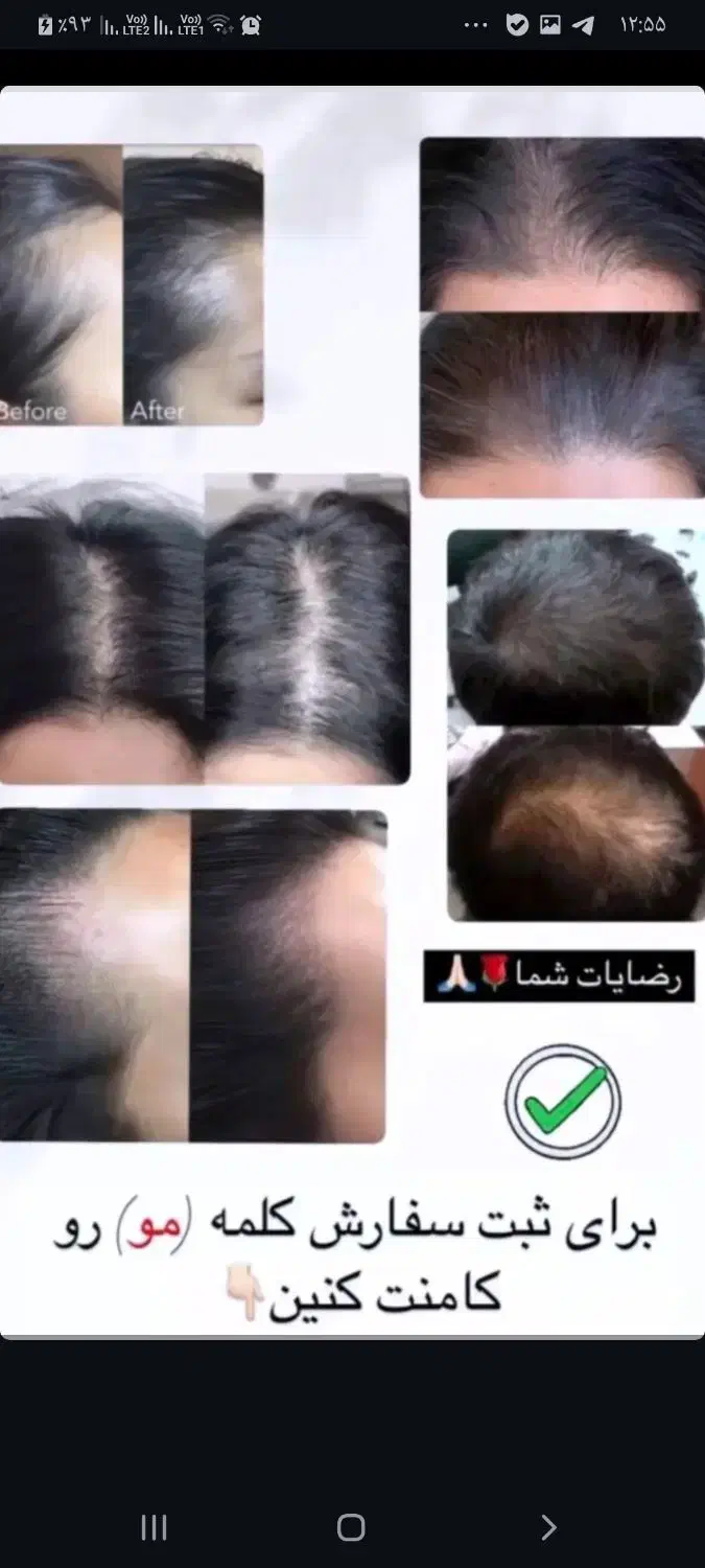 قطع کامل ریزش موباضمانت.تونیک گیاهی هیرفرند|آرایشی، بهداشتی، درمانی|اصفهان, شهرک ولیعصر|دیوار
