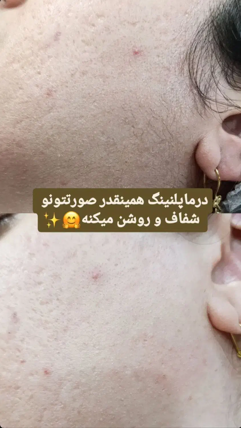 درماپلنینگ تخصصی صورت|خدمات آرایشگری و زیبایی|زابل, |دیوار