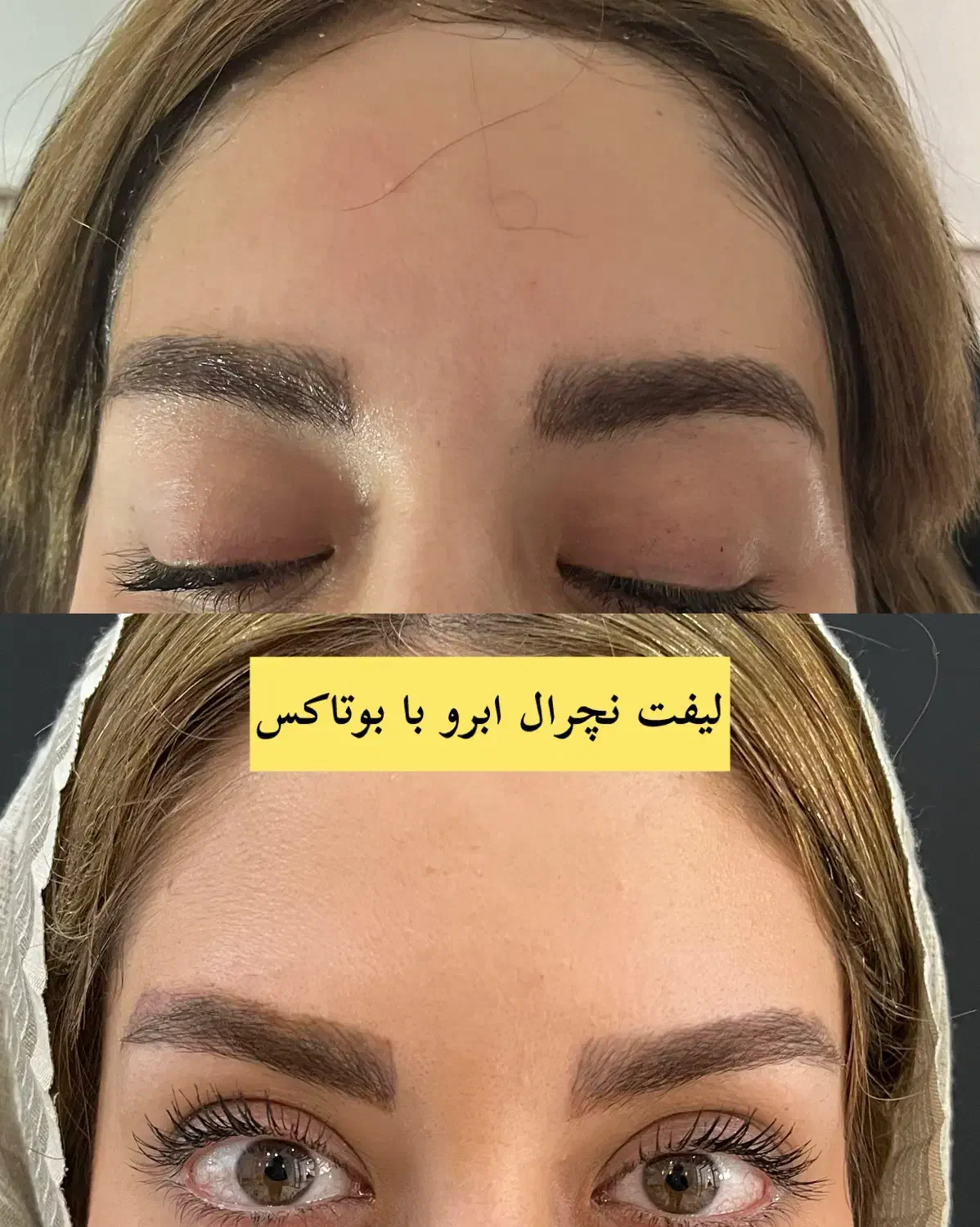 جشنواره ۵۰٪  بوتاکس فول فیس - برج ماندگار عظیمیه|خدمات آرایشگری و زیبایی|کرج, عظیمیه|دیوار
