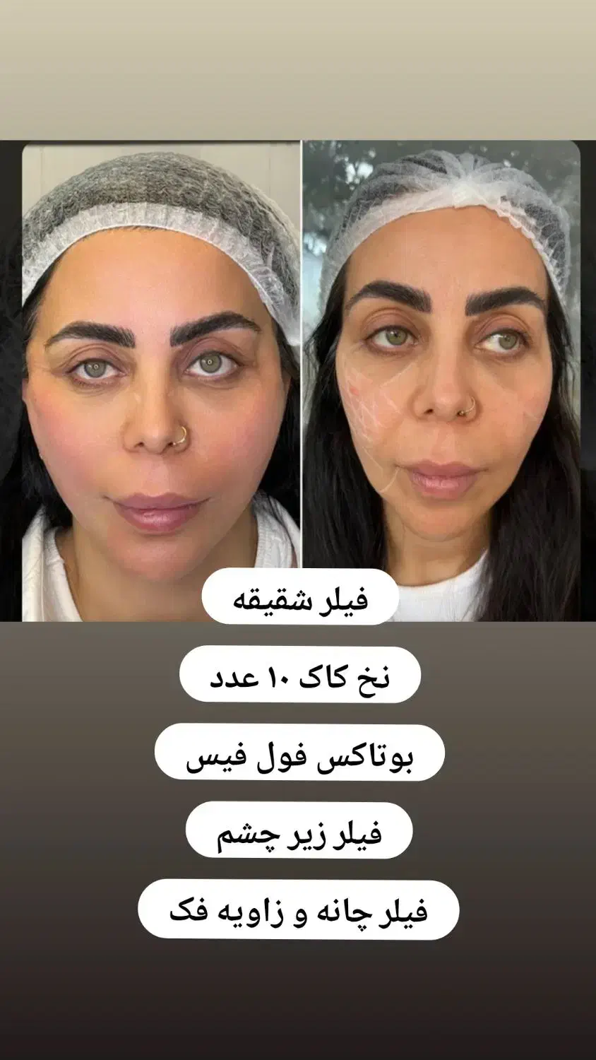 اموزش فیلر و بوتاکس پی ار پی .مزوتراپی|خدمات آموزشی|کرمانشاه, |دیوار