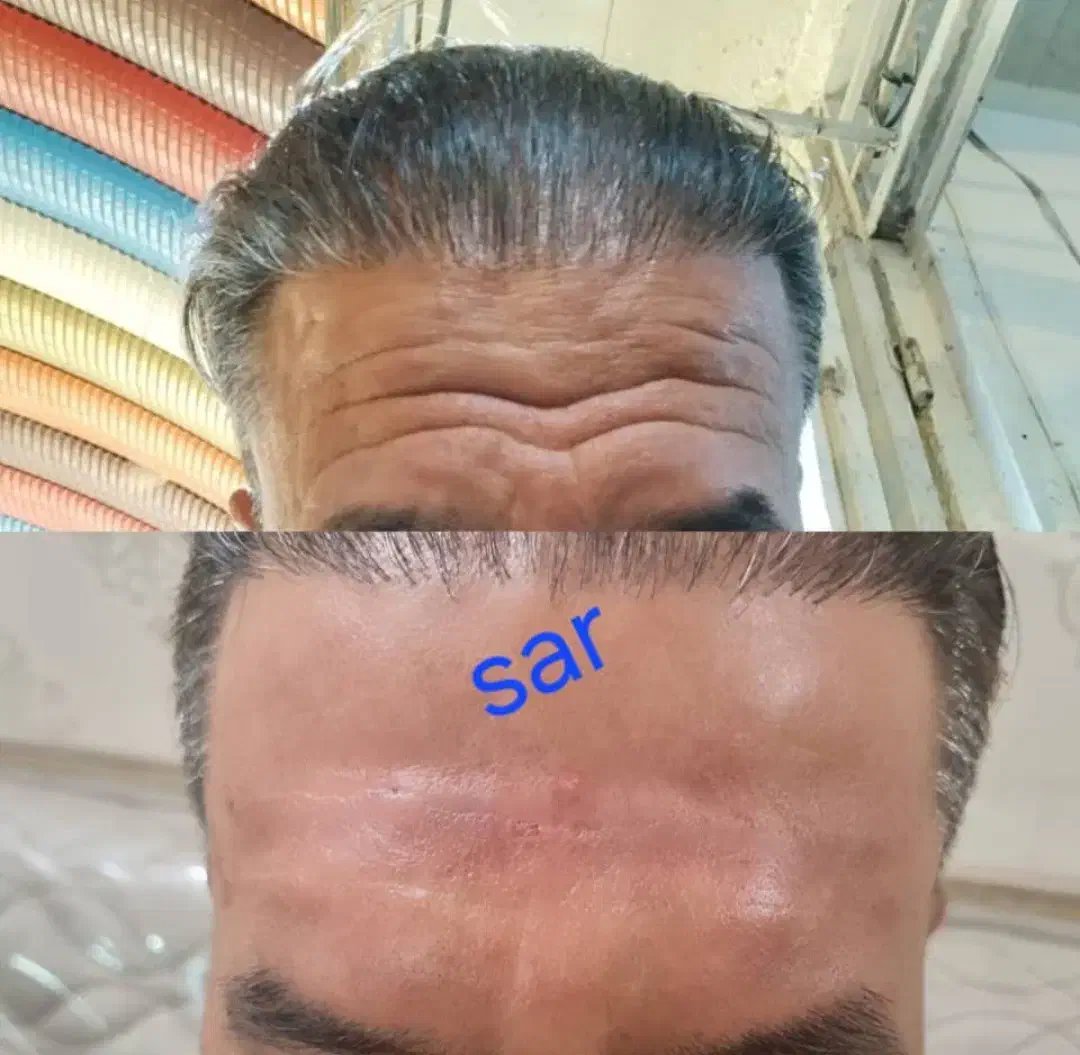 تزریق وآموزش ژل وبوتاکس  ۲۵۰۰ درکلینیک|خدمات آرایشگری و زیبایی|اهواز, بیست متری شهدا|دیوار