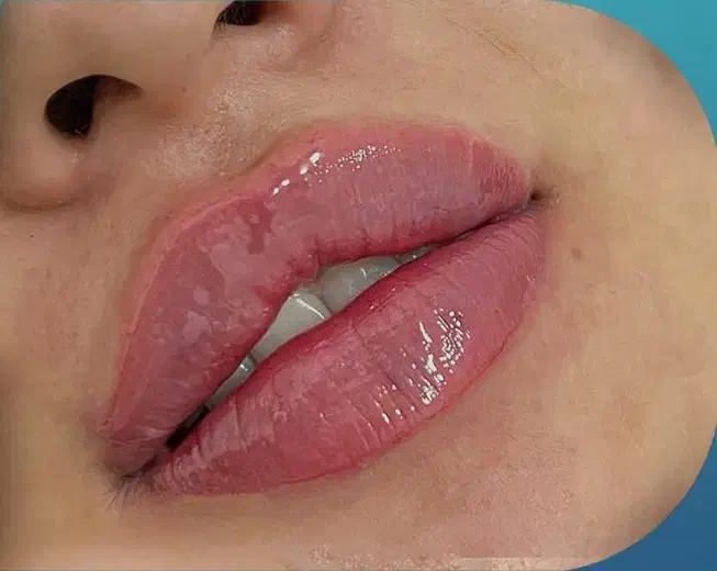 تخفیفات ۵۰% دکتر بوتاکس مزو فیلر ژل لب روسی|خدمات آرایشگری و زیبایی|مشهد, هنرستان|دیوار