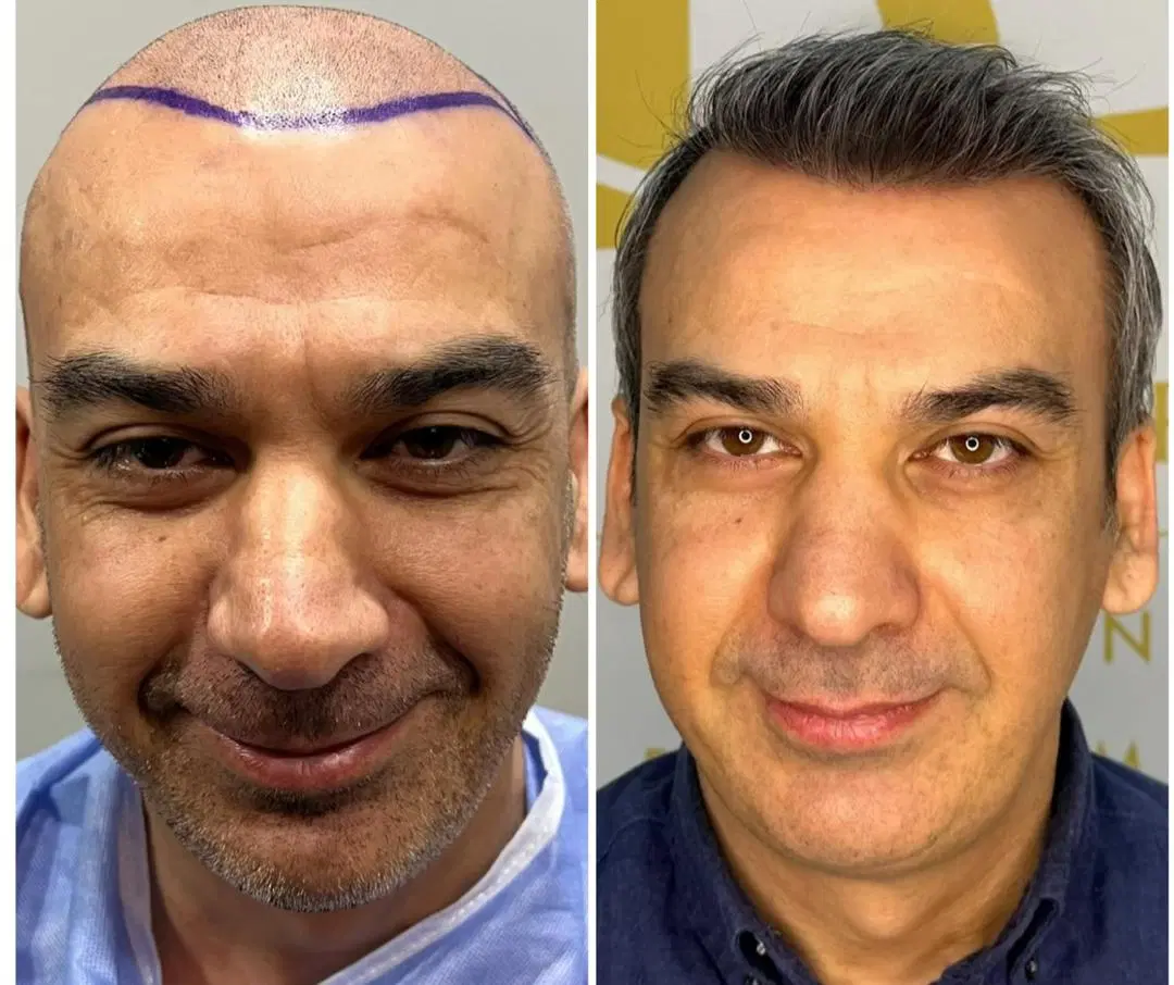 کاشت مو|خدمات آرایشگری و زیبایی|تهران, پاسداران|دیوار