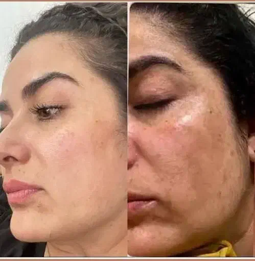 سفیدکردن بیکینی،زیربغل،صورت (کلینیک ایرانا)|خدمات آرایشگری و زیبایی|یاسوج, |دیوار