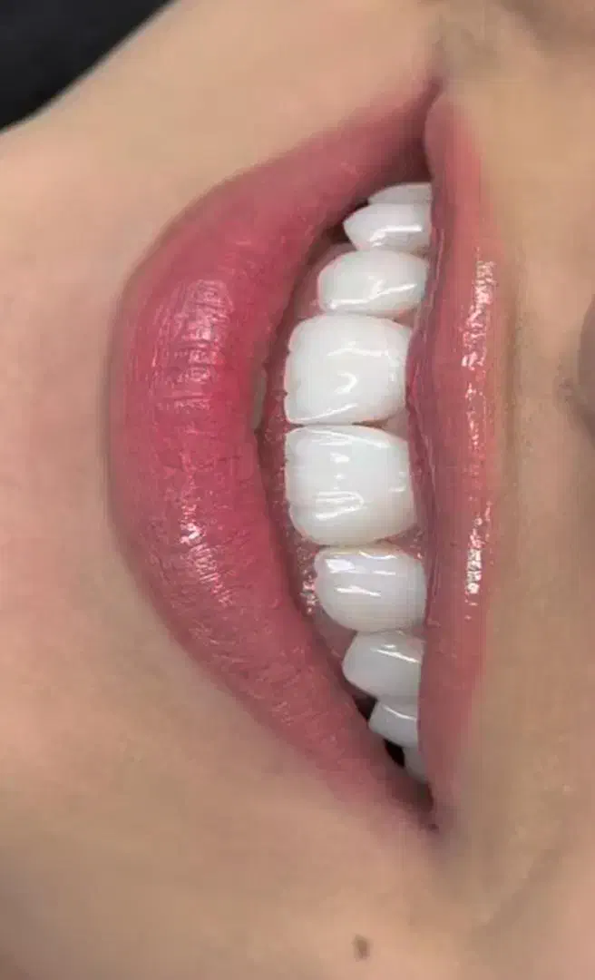 کامپوزیت دندان .۰لیرینگ .لمینت .ونیر|خدمات آرایشگری و زیبایی|ری, تقی آباد|دیوار