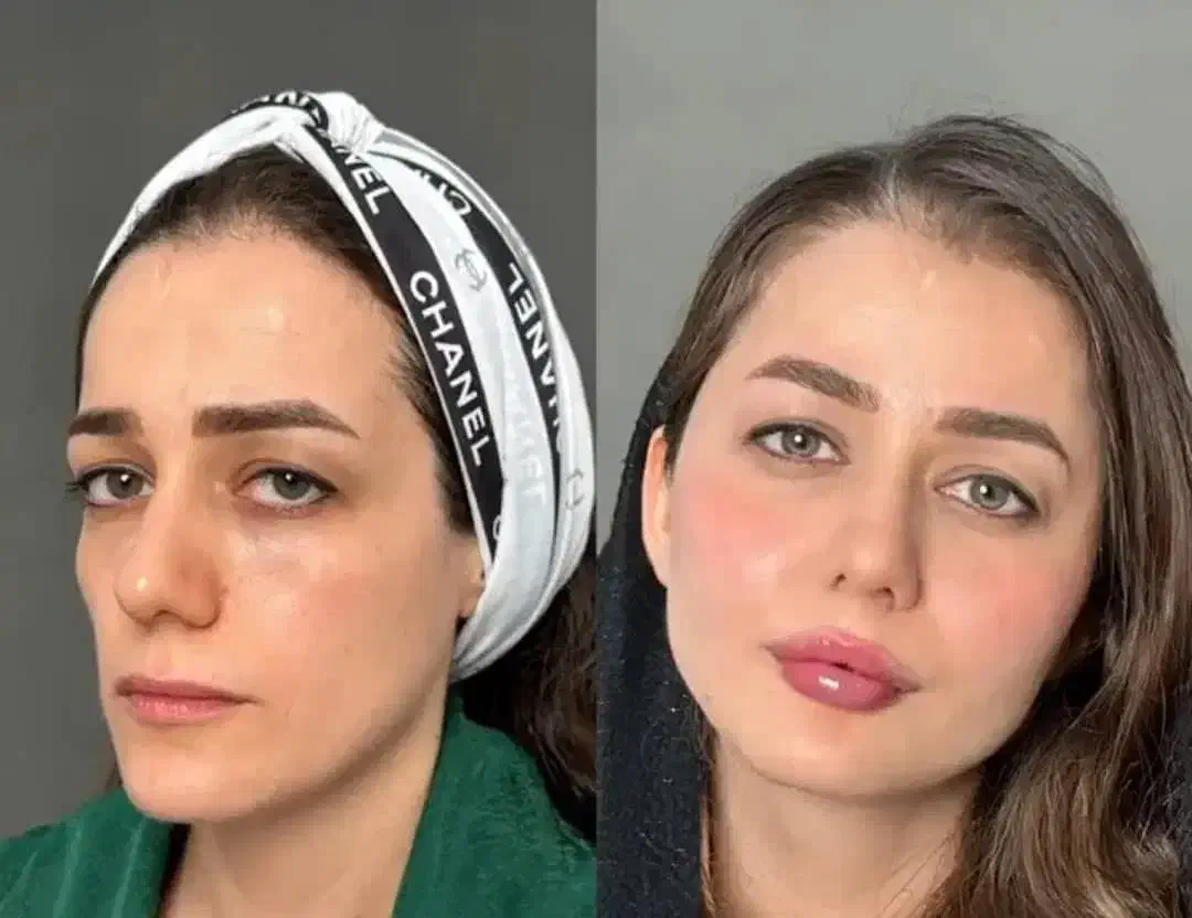 آف ویژه فیلر فول فسی  و مدلینگ صورت فقط ۳۹۰۰|خدمات آرایشگری و زیبایی|کرج, گوهردشت|دیوار