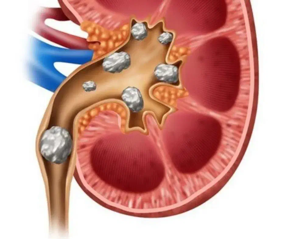 درمان سنگ کلیه بدون لیزر|آرایشی، بهداشتی، درمانی|تهران, تهرانپارس شرقی|دیوار