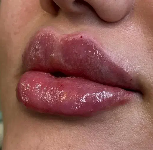 مدل برای فیلر لب و بوتاکس|خدمات آرایشگری و زیبایی|کرمانشاه, |دیوار