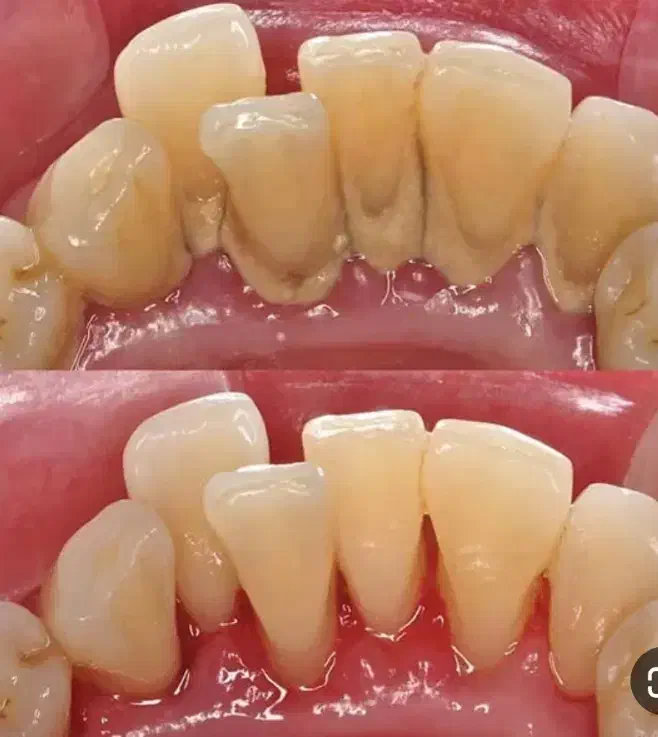 پاکسازی حرفه ای دندان|آرایشی، بهداشتی، درمانی|یزد, |دیوار