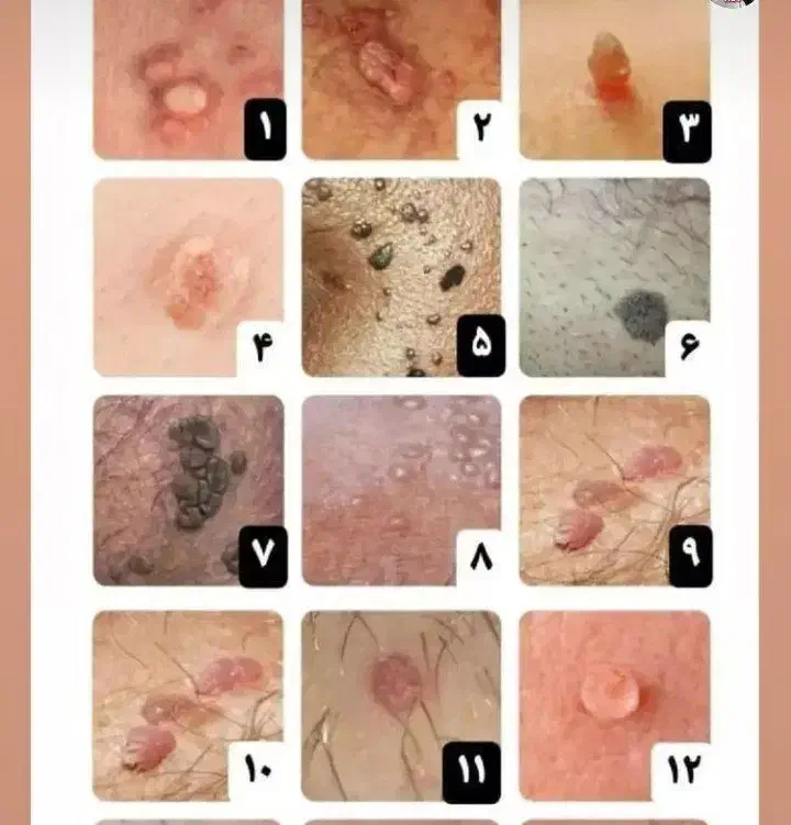 ازبین برندن زگیل تناسلی درکمتراز۱۵روزوبهبودی کامل|خدمات آرایشگری و زیبایی|گرگان, |دیوار