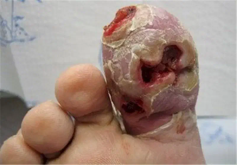 درمان دیابت به صورت تضمینی و تخصصی|خدمات آرایشگری و زیبایی|زرند, |دیوار