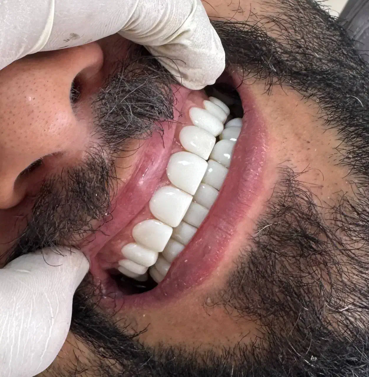 کامپوزیت دندان بابل|خدمات آرایشگری و زیبایی|امیرکلا, |دیوار