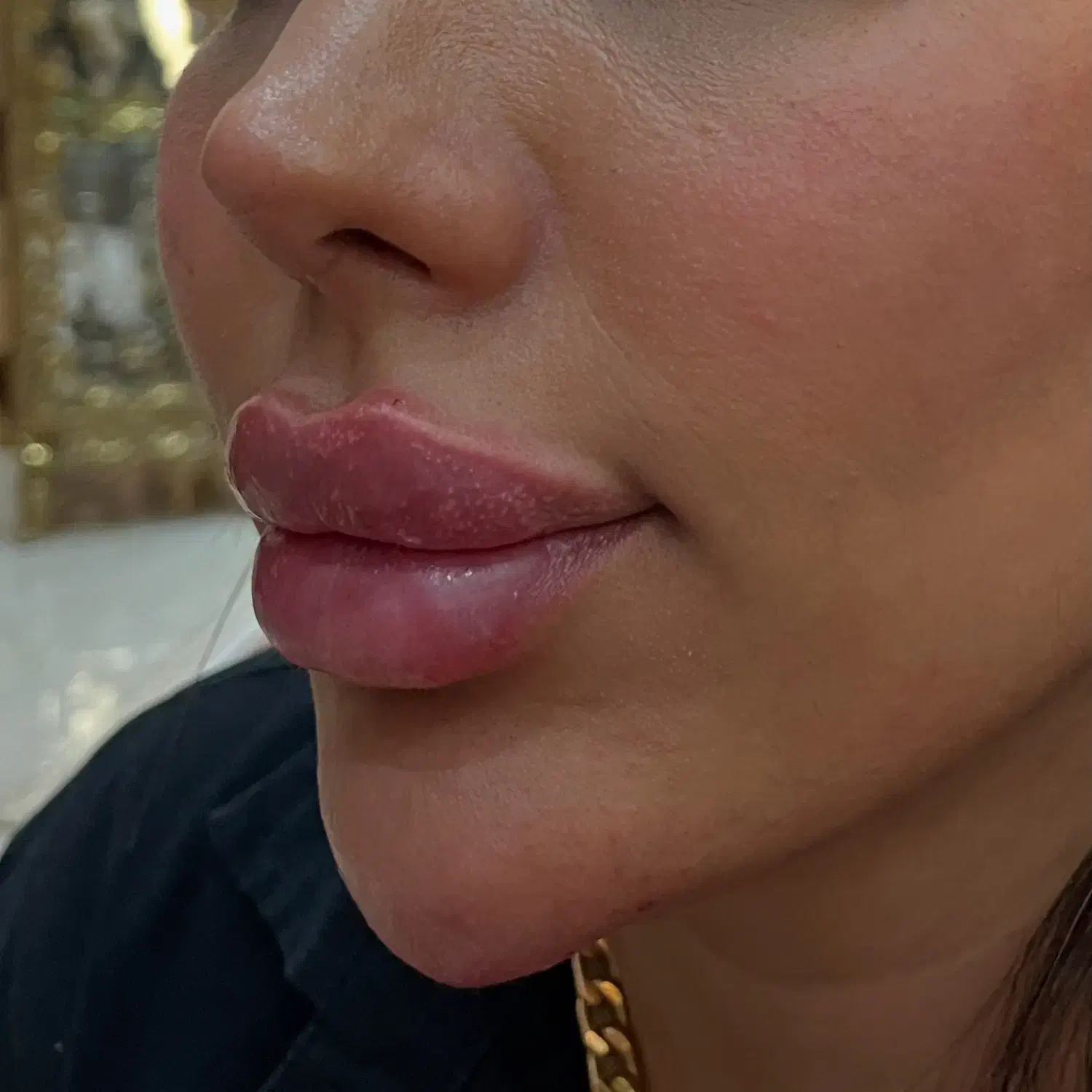 تزریق ژل و بوتاکس فقط۷۵۰|خدمات آرایشگری و زیبایی|هشتگرد, شهرک راه آهن|دیوار