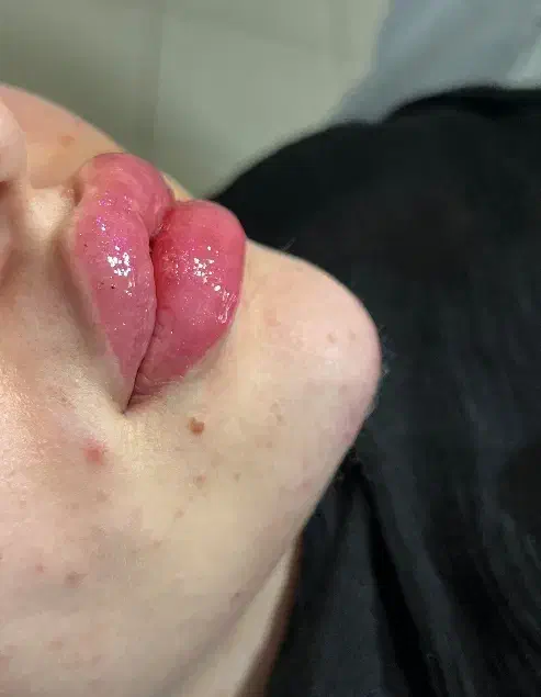 ژل،بوتاکس،مزو،چال لپ،فیلر|خدمات آرایشگری و زیبایی|قم, عمار یاسر|دیوار