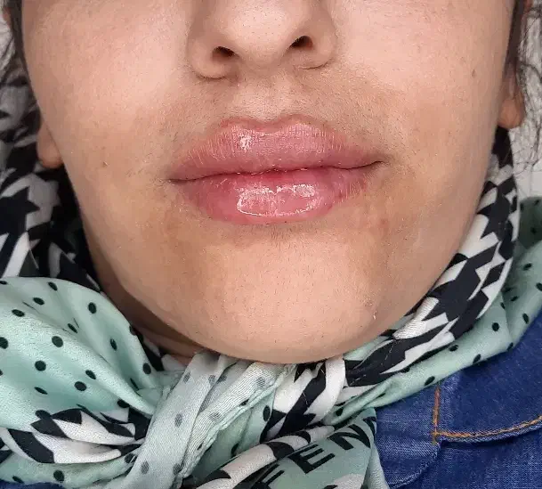 کامپوزیت دندان و ژل لب بزن سکه طلا هدیه بگیر|خدمات آرایشگری و زیبایی|اهواز, کیانپارس |دیوار