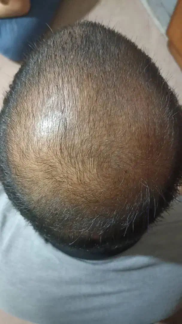 درمان قطعی ریزش مو و رویش مجدد|آرایشی، بهداشتی، درمانی|تهران, چیتگر شمالی|دیوار