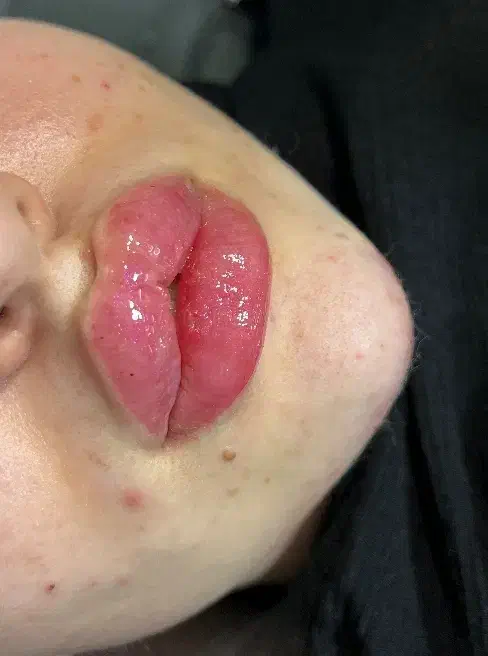 ژل،بوتاکس،مزو،چال لپ،فیلر|خدمات آرایشگری و زیبایی|قم, عمار یاسر|دیوار