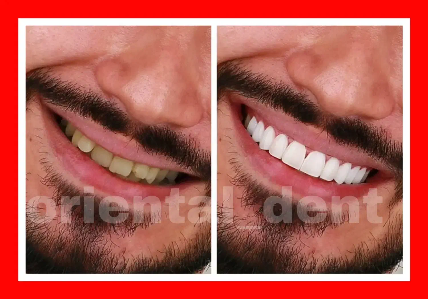 بریج و کامپوزیت و لیفت لثه جرمگیری دندان عصبکشی|خدمات آرایشگری و زیبایی|تهران, تهرانپارس غربی|دیوار