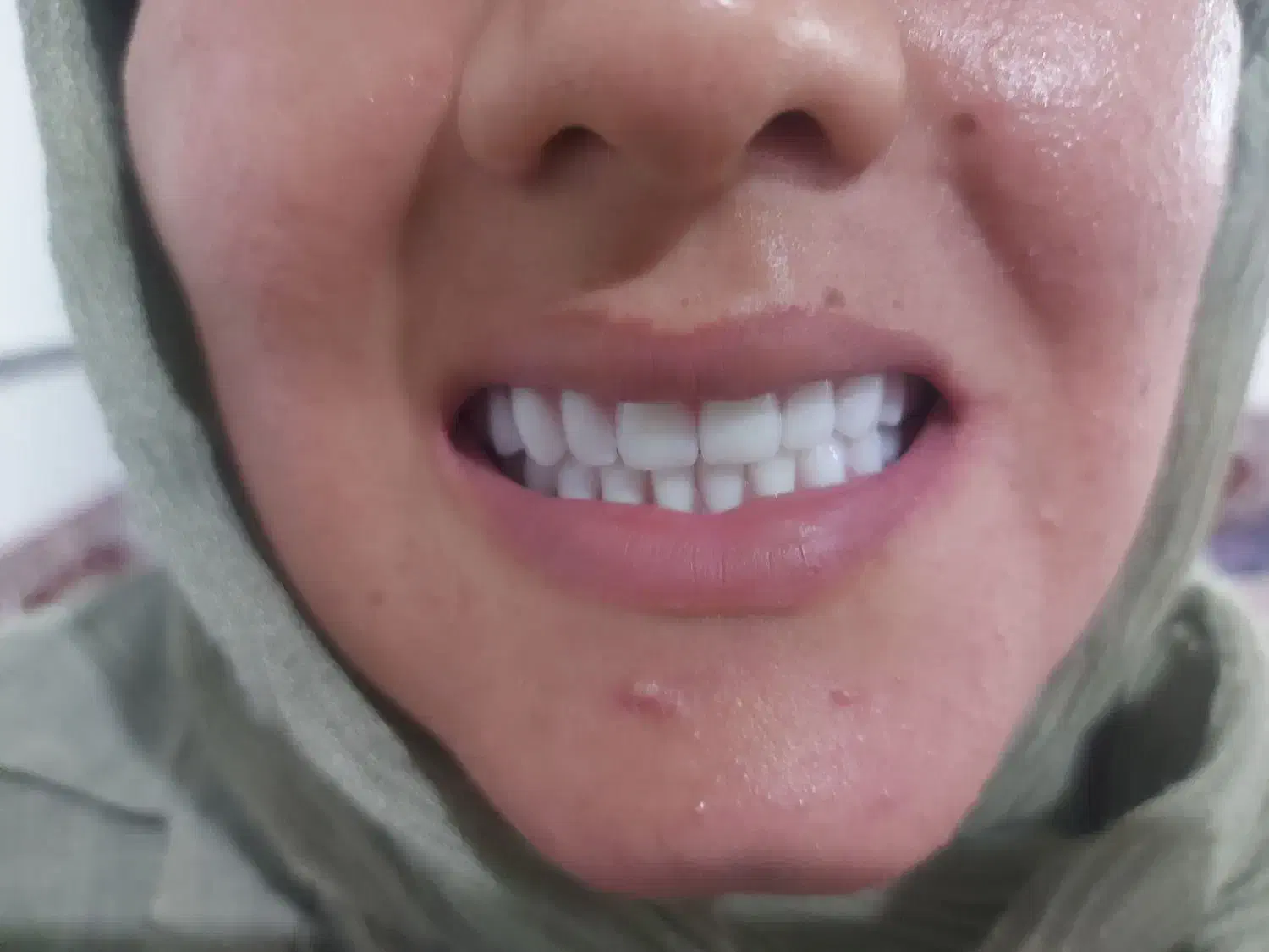 دندان متحرک مصنوعی بقیمت سنندج۶/۵ زرین آباد ایجرود|فعالیت داوطلبانه تحقیقاتی|زنجان, |دیوار