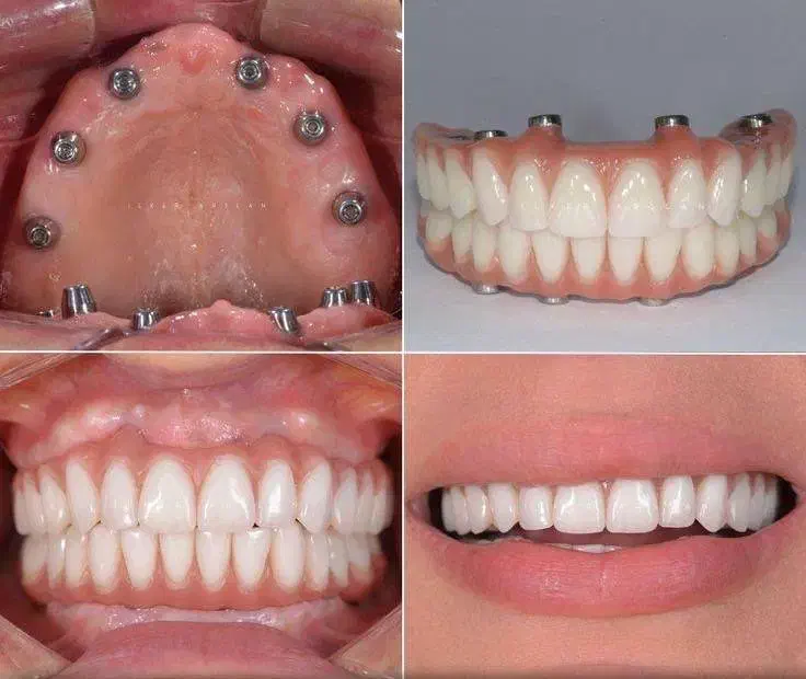 دندانپزشکی اوردنچر دو فک فقط ۱۰۰ تومن|خدمات آرایشگری و زیبایی|هریس, |دیوار