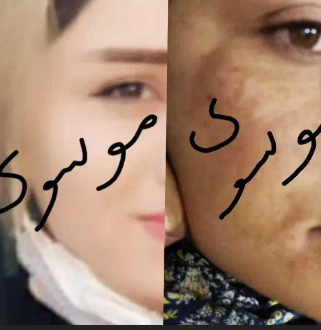 روشن کننده و رفع هرنوع مشکل پوستی بدون بازگشت|آرایشی، بهداشتی، درمانی|لردگان, |دیوار