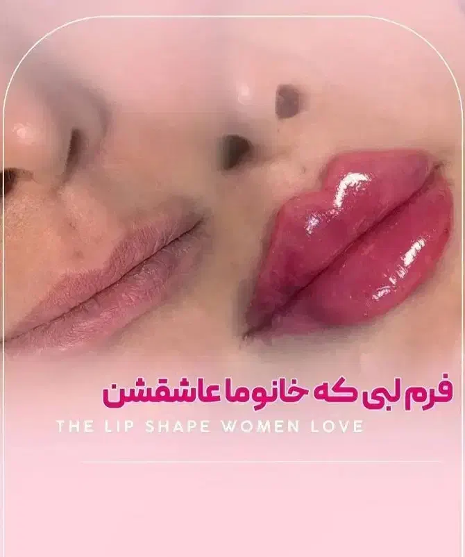 تزریق ژلفیلر،لب،گونه(جشنواره یلدا)درمطب فقط499ت|خدمات آرایشگری و زیبایی|اصفهان, باغ زیار|دیوار