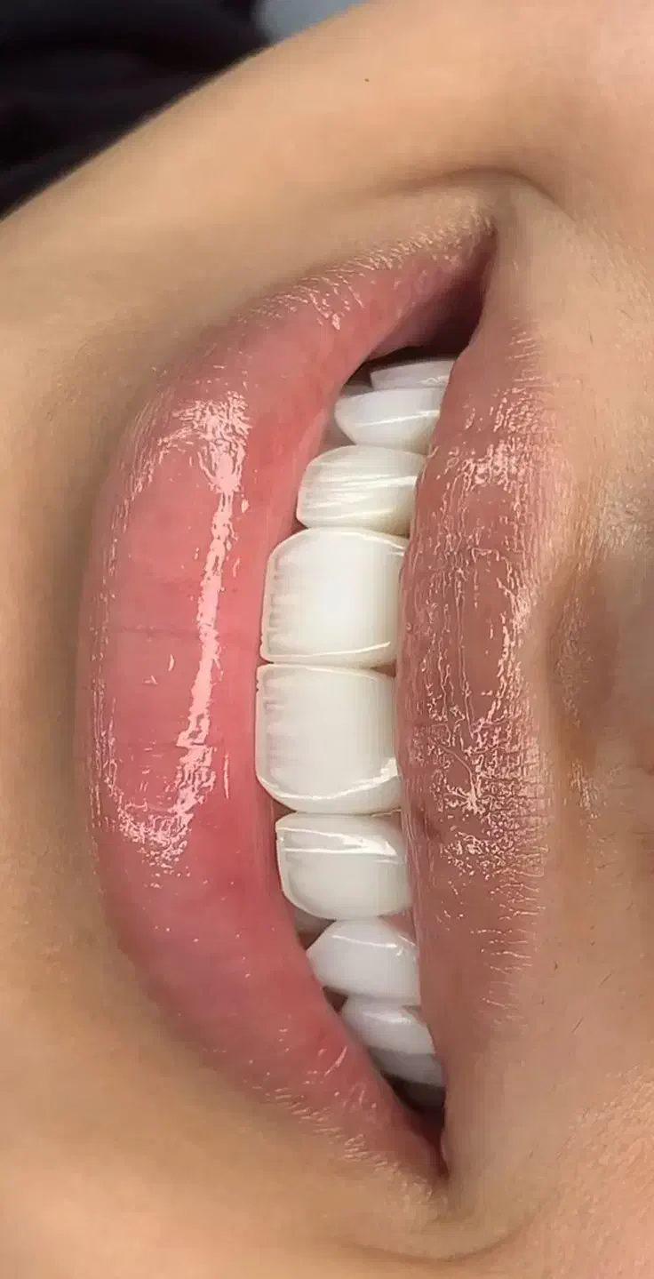 کامپوزیت، لمینت، ایمپلنت دندان اقسا*طی|خدمات آرایشگری و زیبایی|مشهد, شریف|دیوار