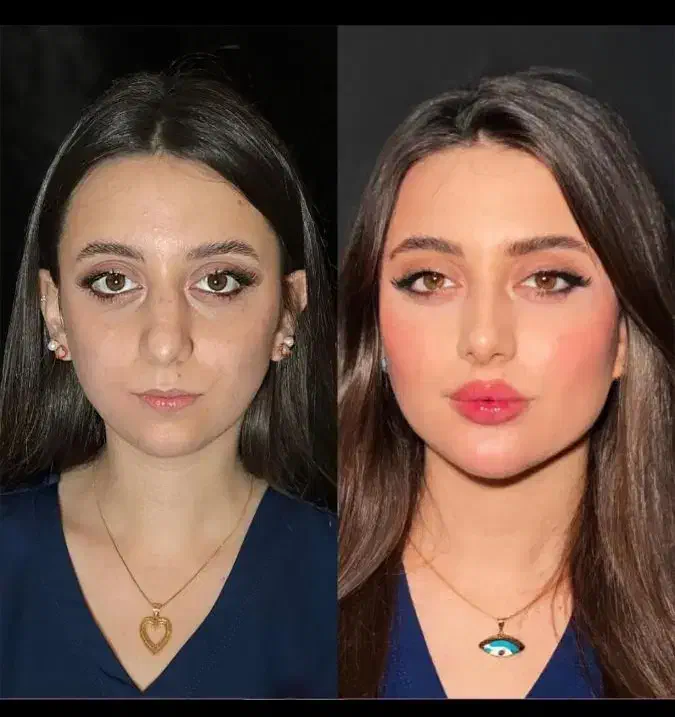 تزریق ژل فیلربوتاکس تخفیفات50درصدی برای زیباجویان|خدمات آرایشگری و زیبایی|زاهدان, |دیوار