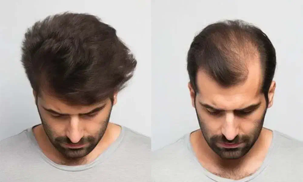 پروتزمو/ تعویض چسب/تخفیف ویژه|خدمات آرایشگری و زیبایی|شیراز, فرگاز|دیوار