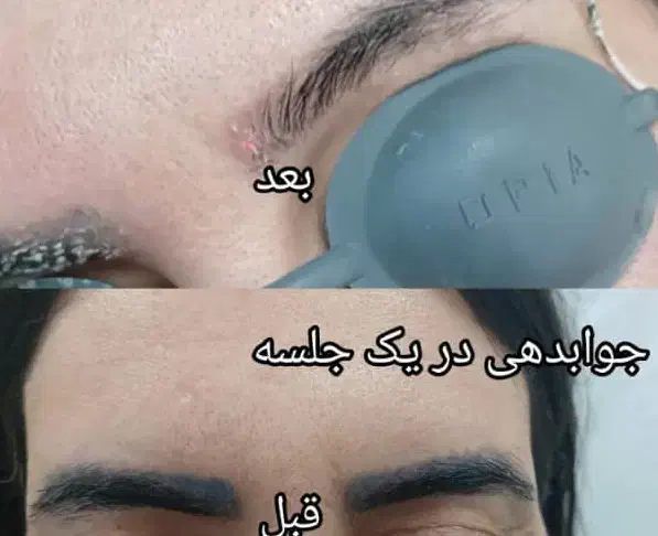 لیزر پاک کردن تتو ابرو و بدن و خالکوبی قدیمی|خدمات آرایشگری و زیبایی|اهواز, اهواز|دیوار