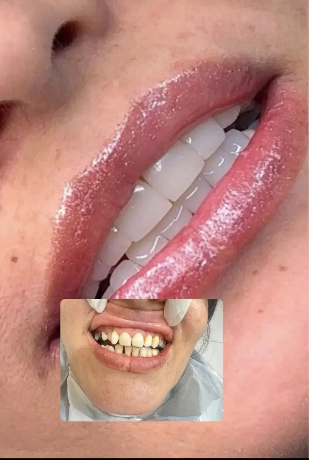 تخفیف کامپوزیت ونیر دندان|خدمات آرایشگری و زیبایی|اردبیل, |دیوار