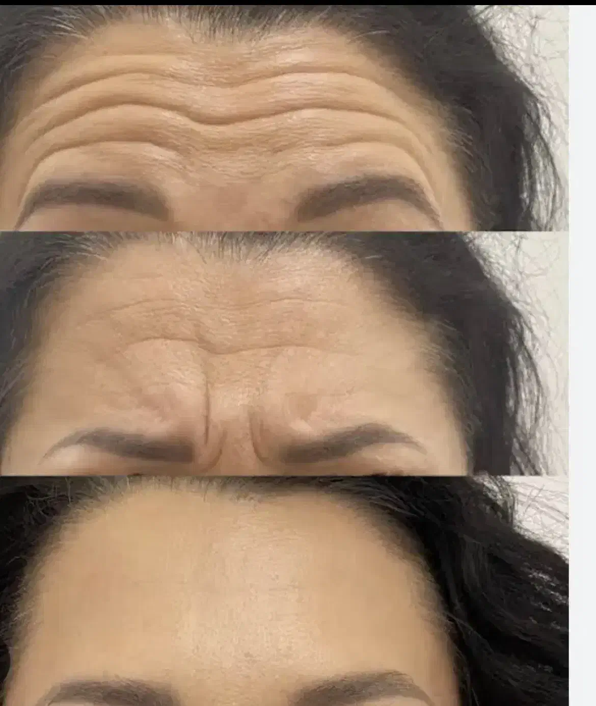 تخفیفات بزرگژل وبوتاکس در مشهد|خدمات آرایشگری و زیبایی|مشهد, کوثر|دیوار