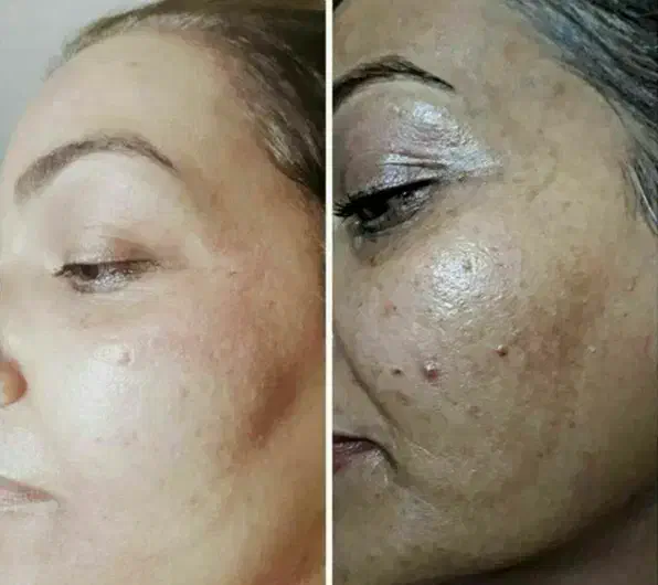 زیبایی لیفت بلفارو فرم بینی بوتاکس نخ ابروزاویه ژل|خدمات آرایشگری و زیبایی|اصفهان, خانه اصفهان|دیوار