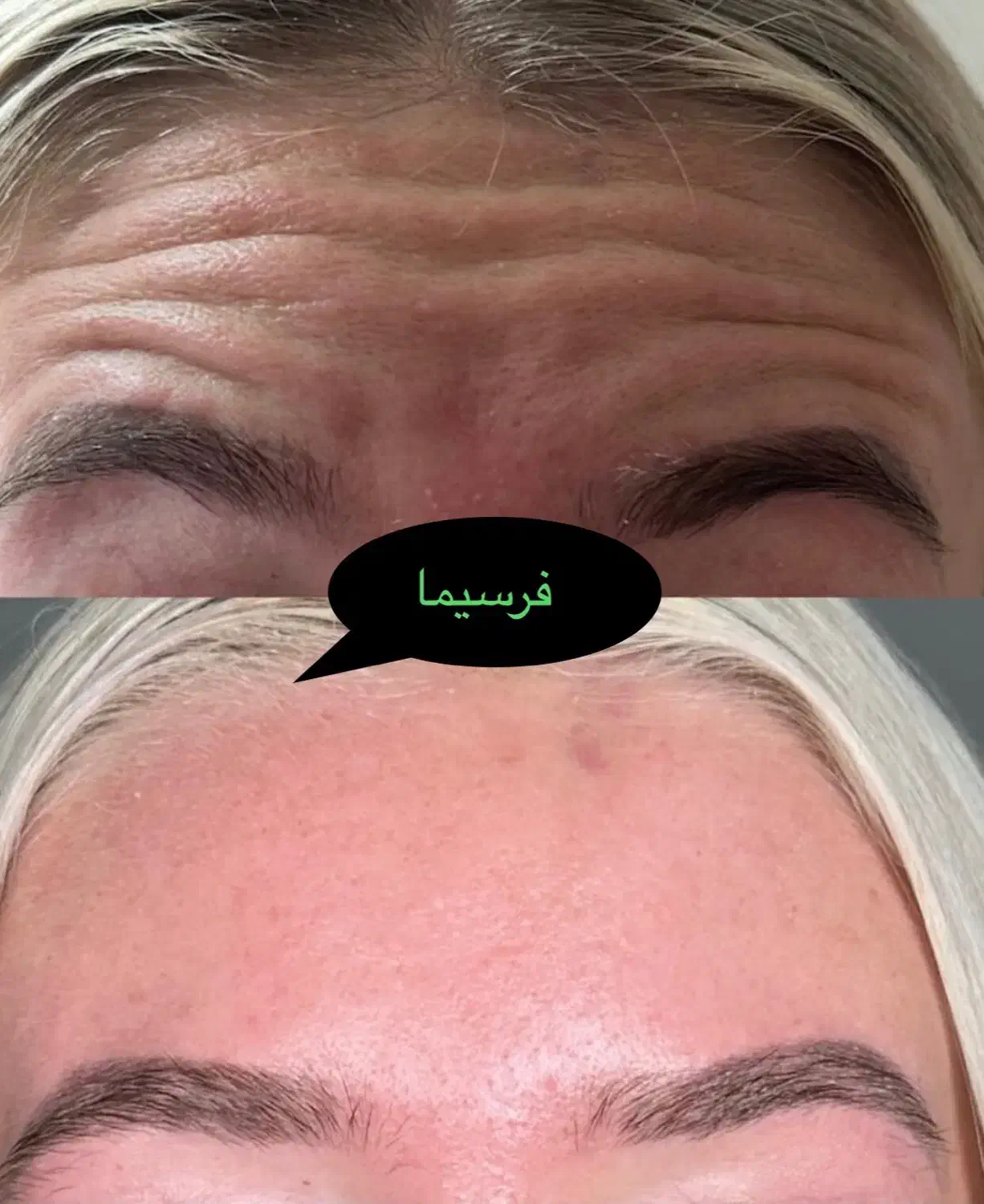 جشنواره تابستانه بوتاکس خال لاغری مزو‌ موفرسیما|خدمات آرایشگری و زیبایی|همدان, |دیوار
