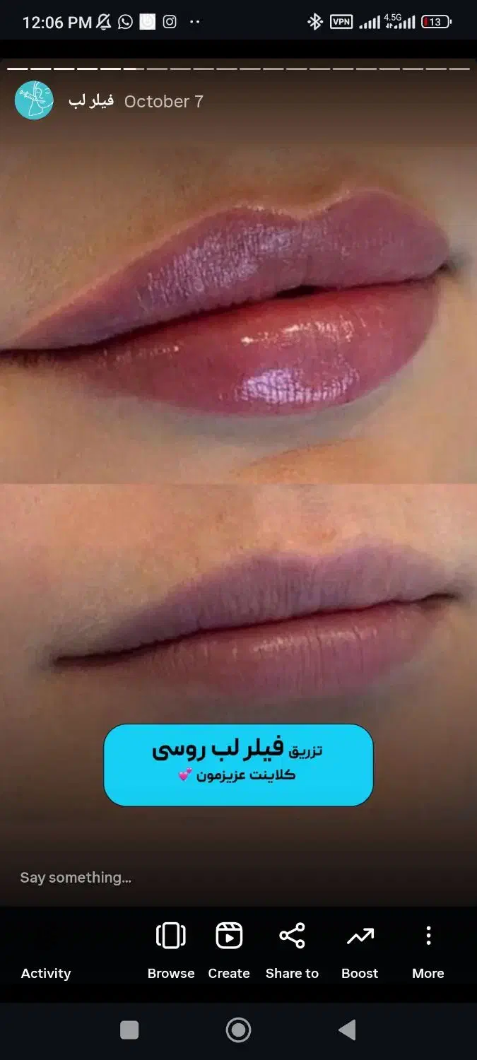 خدمات زیبایی تزریق فیلر ،بوتاکس و لیزر در مطب پزشک|خدمات آرایشگری و زیبایی|قم, نیروگاه|دیوار