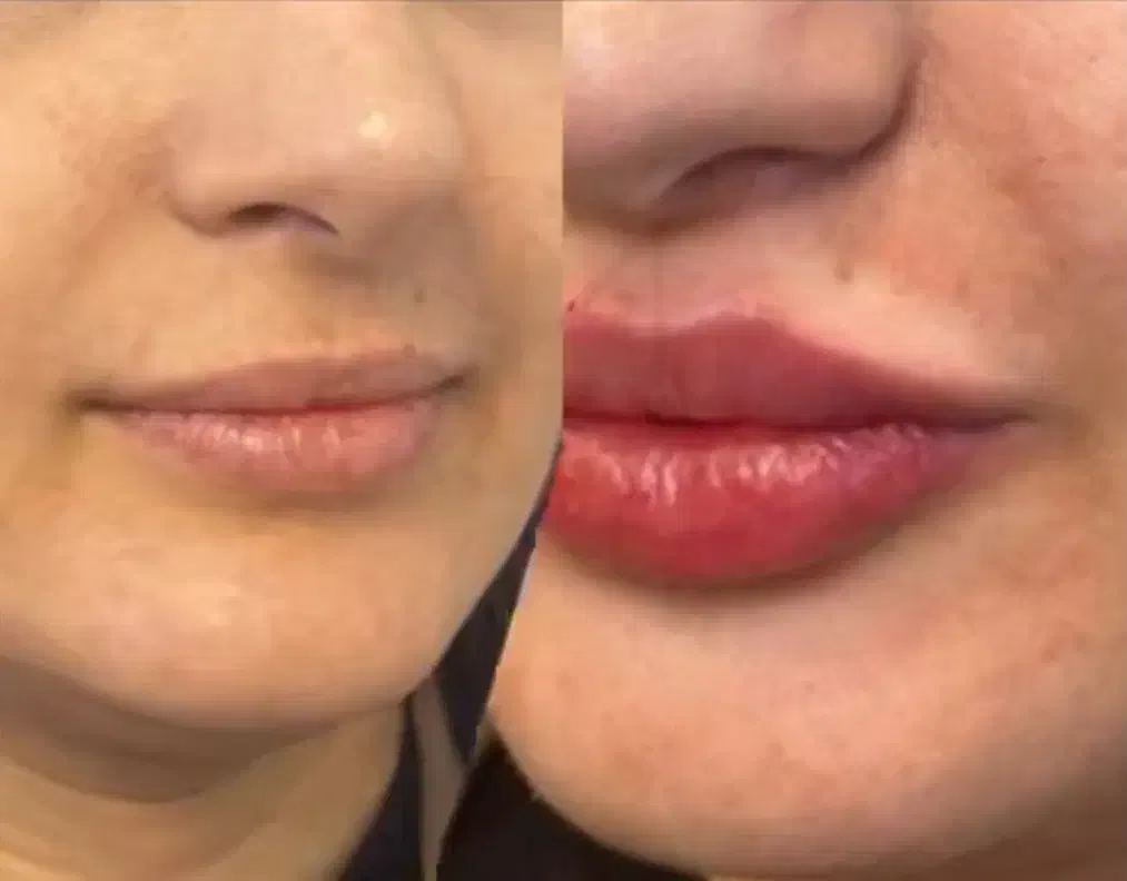 تخفیف ویژه ژل و فیلر|خدمات آرایشگری و زیبایی|گلبهار, شهر جدید گلبهار|دیوار