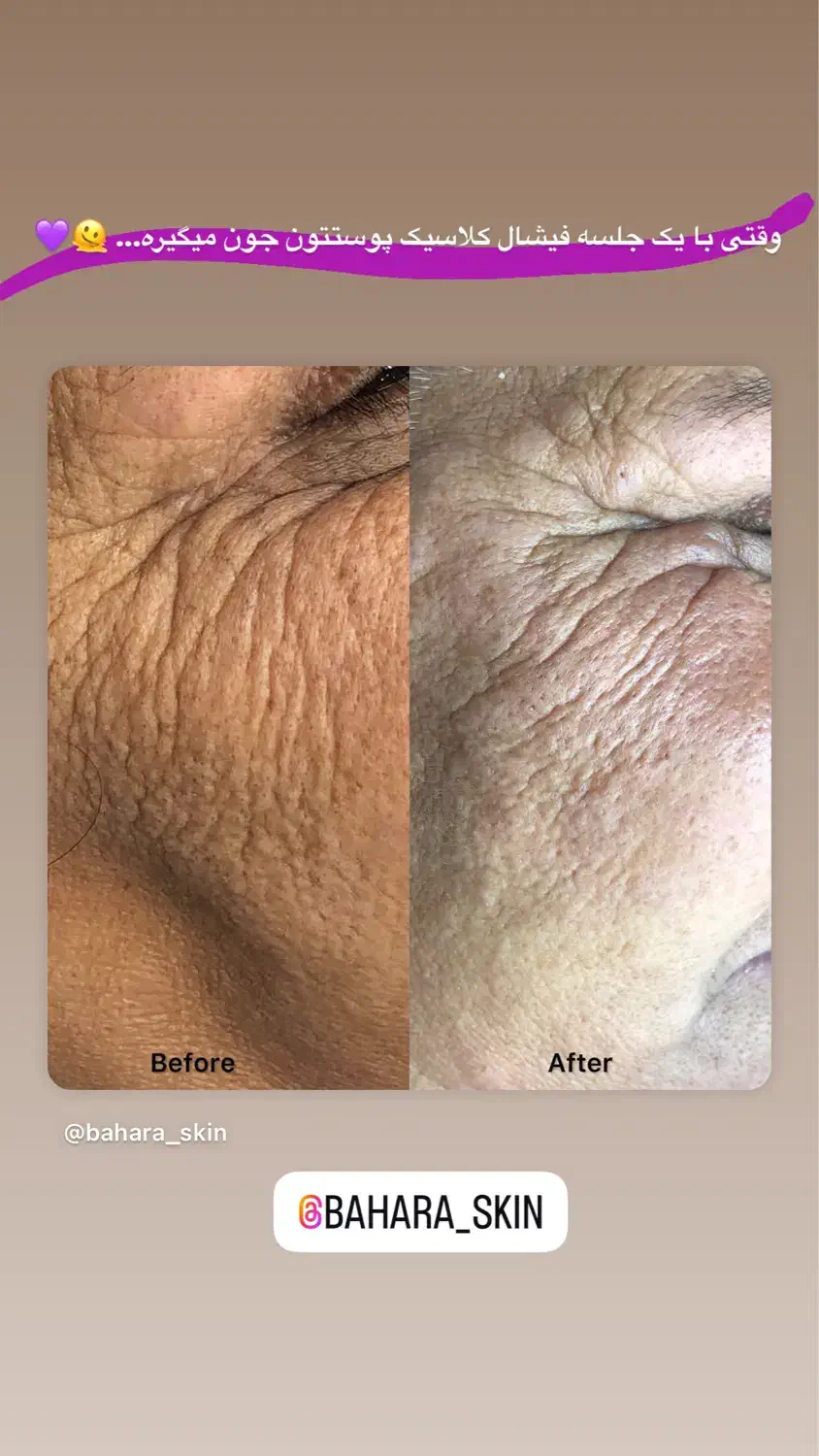 تخفیف فیشیال کلاسیک(رفع جوش سرسیاه)|خدمات آرایشگری و زیبایی|دوگنبدان, |دیوار