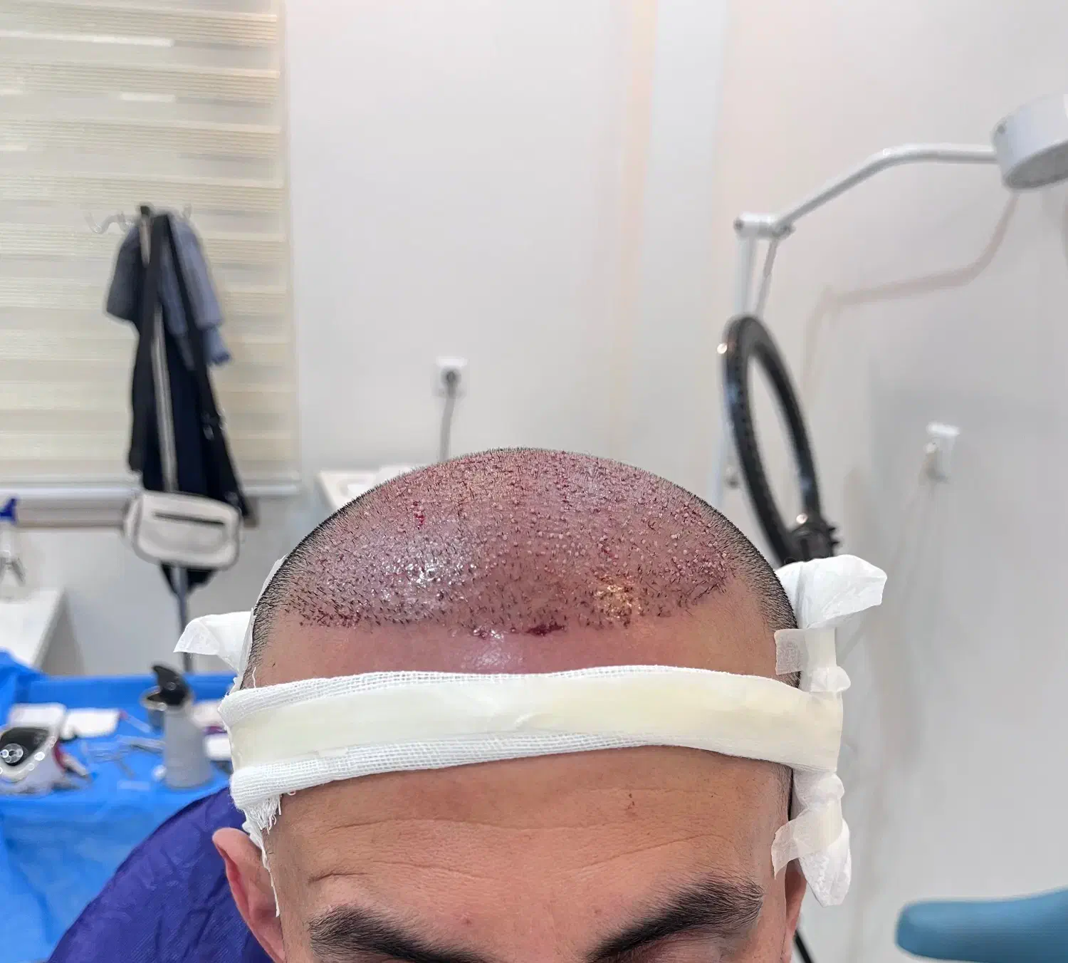 کاشت سر و ابرو|خدمات آرایشگری و زیبایی|بابل, |دیوار