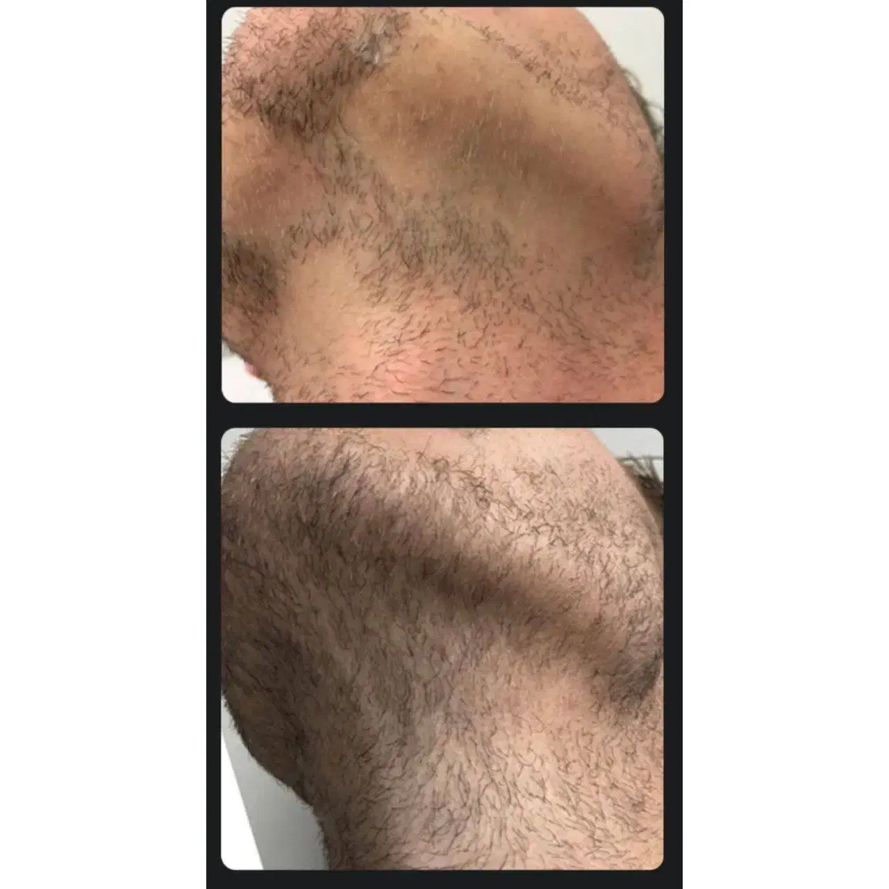 پرپشتی ریش بدون کاشت و خون ریزی|آرایشی، بهداشتی، درمانی|مرودشت, بیست متری بیمارستان|دیوار