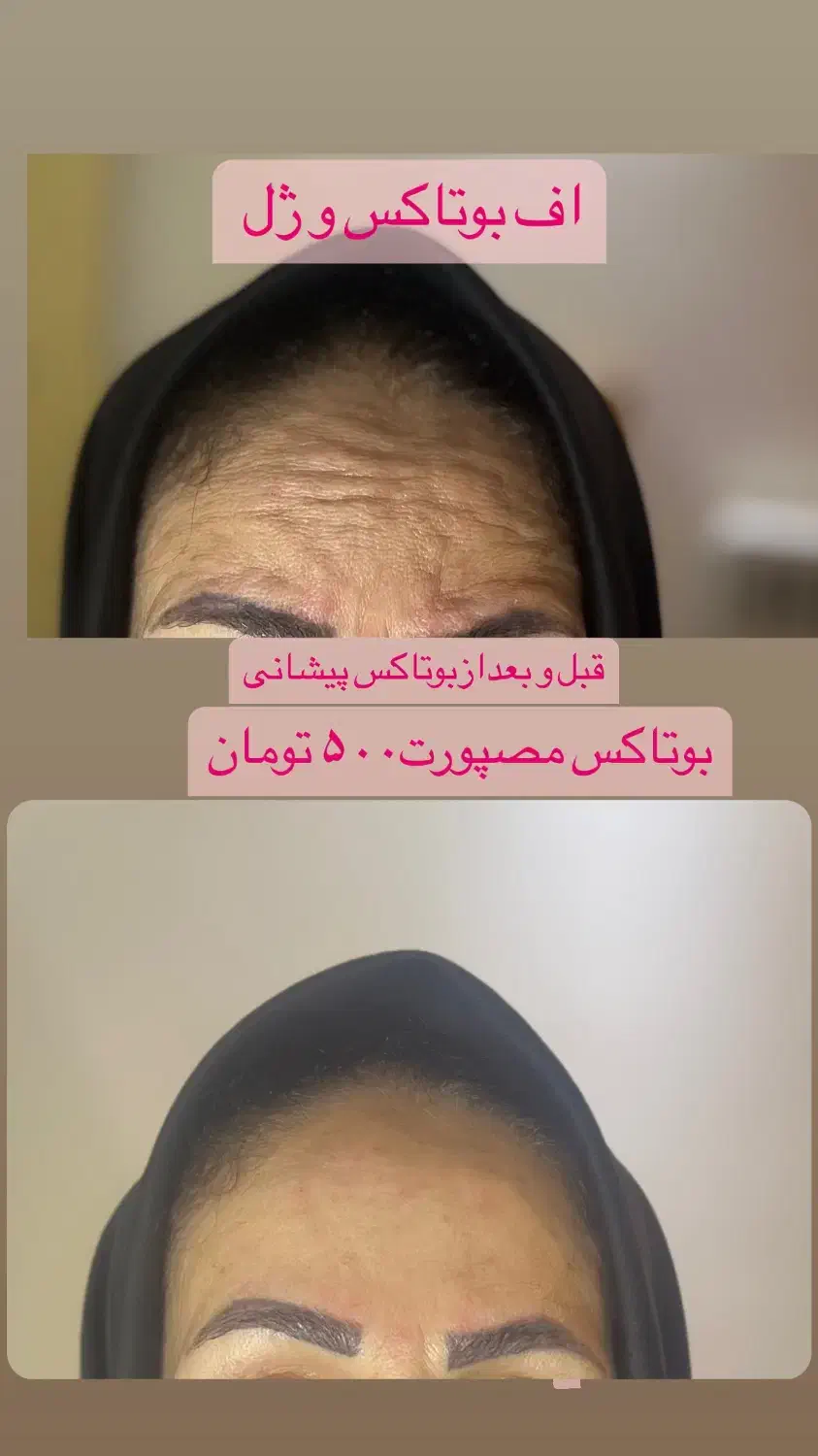 آف تزریق ژل وبوتاکس ومزوژل جوانساز|خدمات آرایشگری و زیبایی|آمل, |دیوار