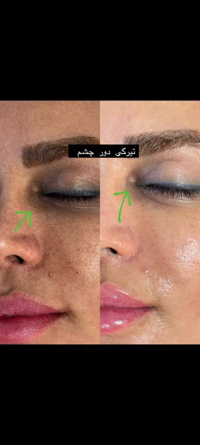 جوانسازی ،درمان پوست ،فیشال،پاکسازی،پوست کره ای|خدمات آرایشگری و زیبایی|شیراز, قدوسی غربی|دیوار