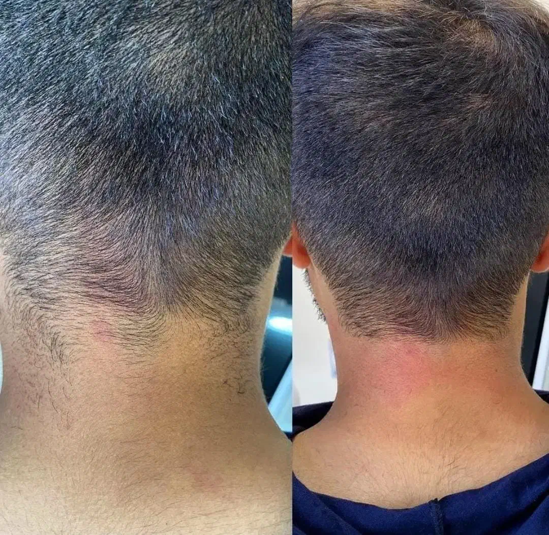 جدیدترین دستگاه لیزر 2025 در شهر جم|خدمات آرایشگری و زیبایی|جم, |دیوار