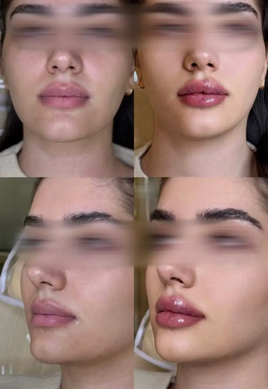 جشنواره ژل و بوتاکس با قیمت باورنکردنی/اقساط|خدمات آرایشگری و زیبایی|آمل, |دیوار