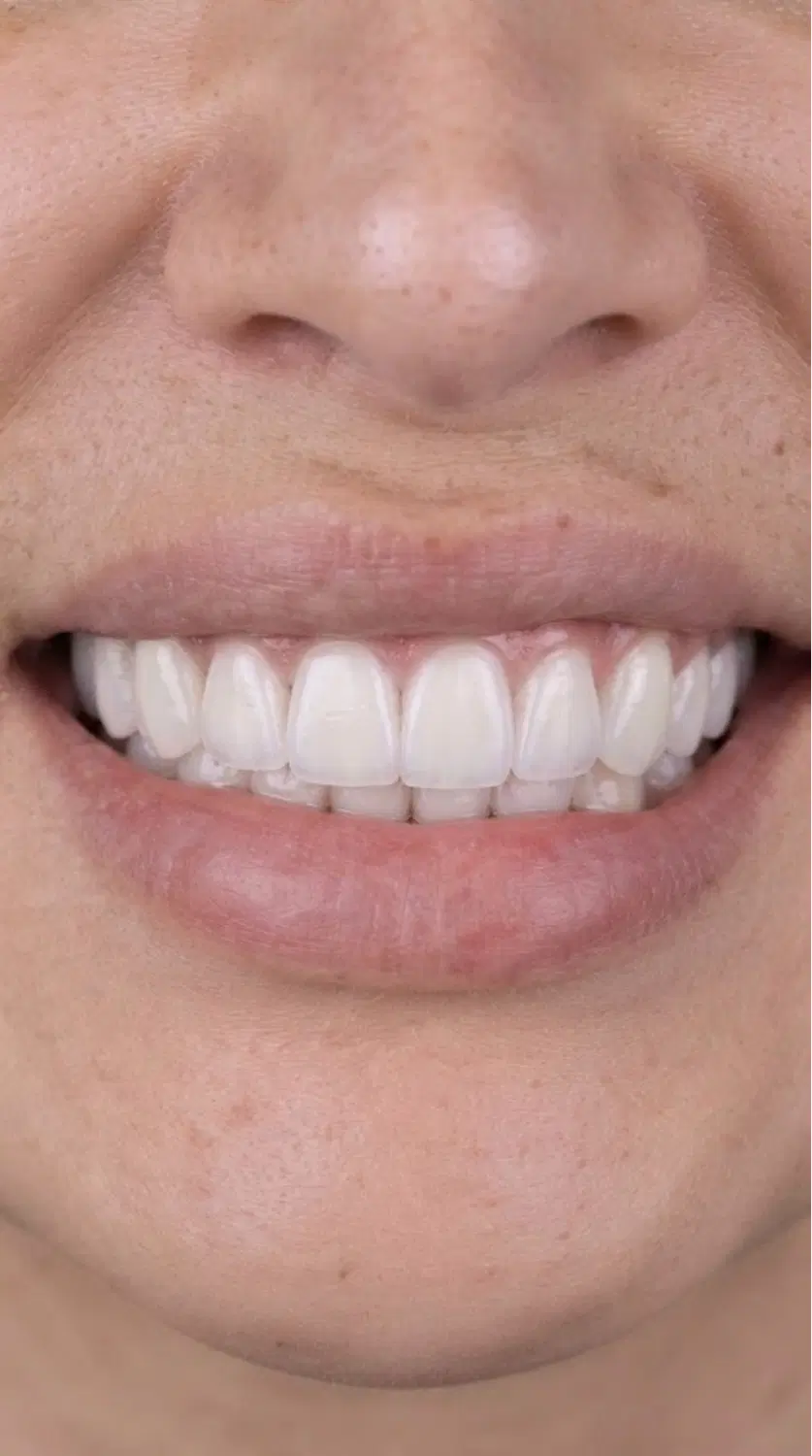 تخفیف کامپوزیت لمینت دندان عصبکشی روکش ایمپلنت|خدمات زیبایی و سلامت|شیراز, قصرالدشت|دیوار
