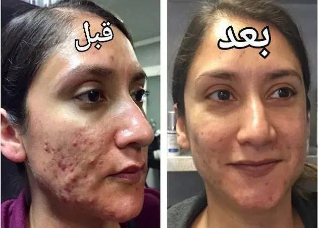 درمان جوش با بهترین روش و محصول|آرایشی، بهداشتی، درمانی|اهواز, ۲۰۰۰واحدی|دیوار