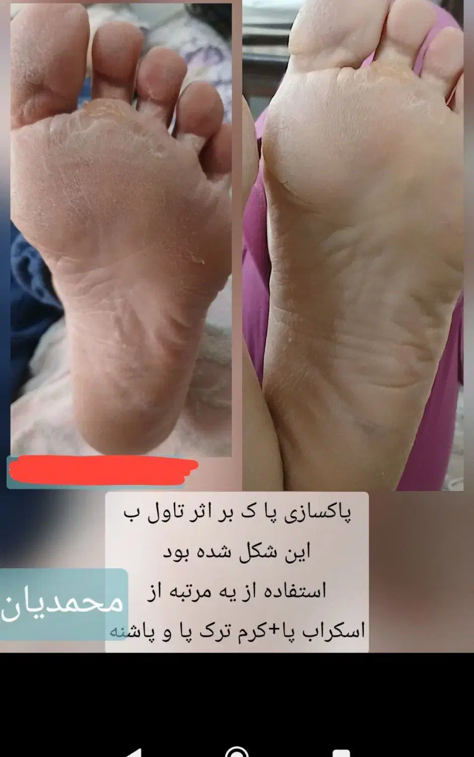 درمان خشکی و ترک پا|آرایشی، بهداشتی، درمانی|تربت جام, امام|دیوار