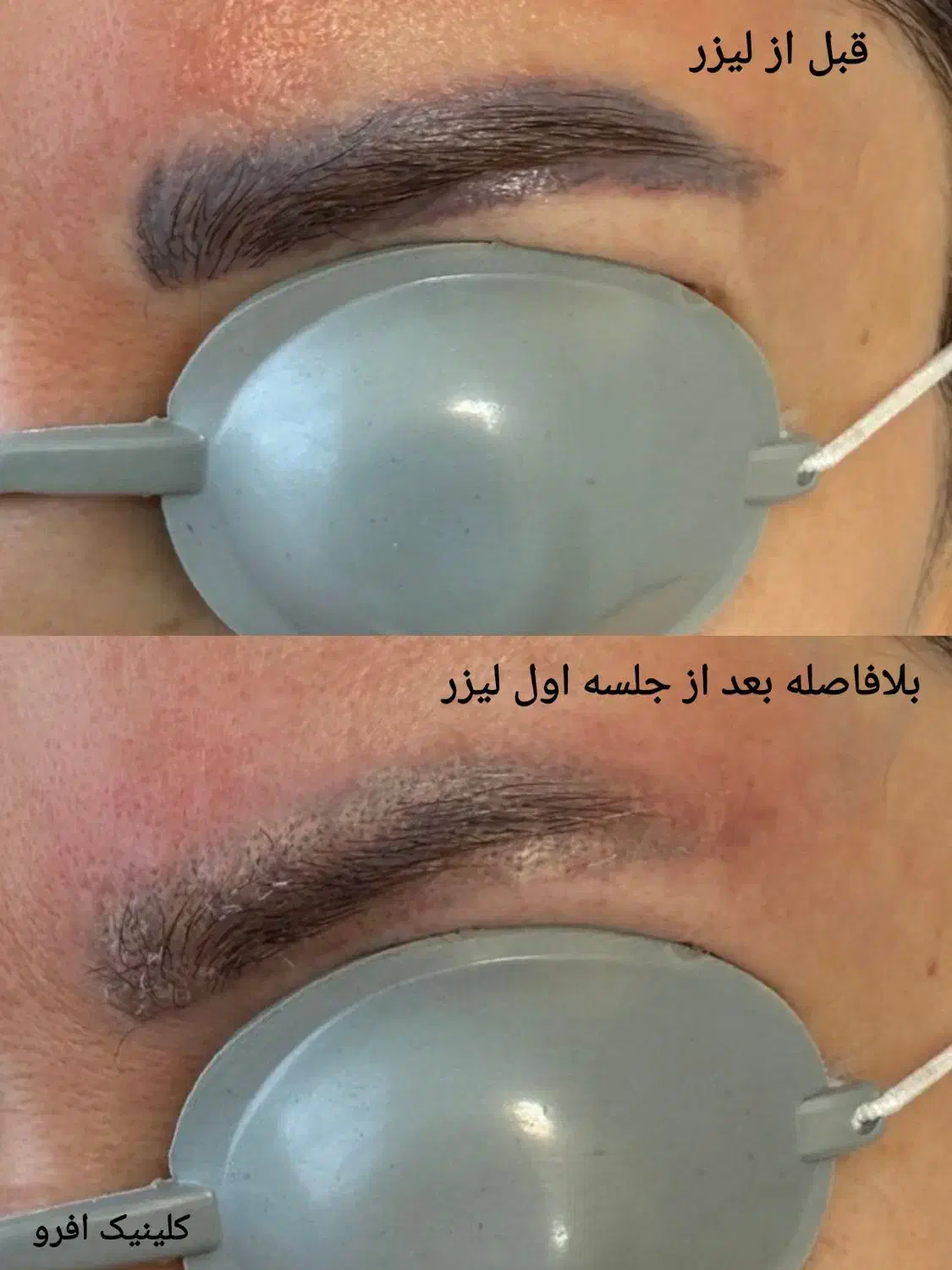 پاک کردن تتو با لیزر کیوسوییچ تضمینی|خدمات آرایشگری و زیبایی|تهران, نیروی هوایی (پیروزی)|دیوار